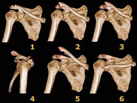 Acromioclavicular Joint Separation – Undergraduate Diagnostic Imaging Fundamentals