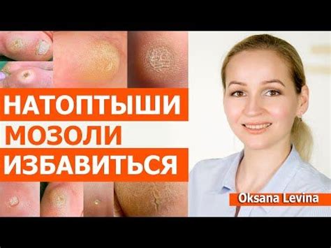 Мозоли и натоптыши, как убрать. Почему образуются и как избавиться от ...