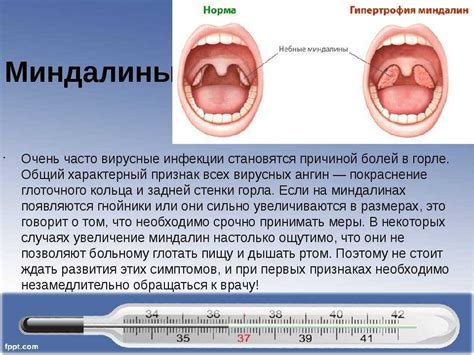 Ангина: что это такое, её причины и виды, возбудители, симптомы и ...