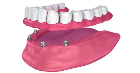 Affordable Denture Implants - Smile Confidently with DentureBracket!