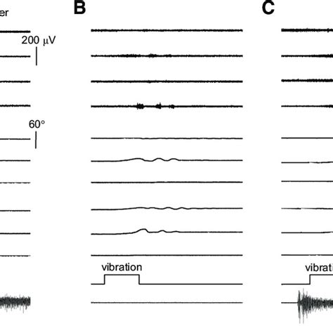 An Example Of 2 Legged Movements During The Jendrassik Maneuver A Download Scientific