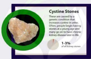 Types of Kidney Stones - Homeo Solutions