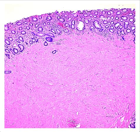 Leiomyoma Nodular Submucosal Proliferation Of Smooth Muscle