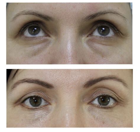 Блефаропластика век отзывы фото (с большим количеством фото) - artshots.ru