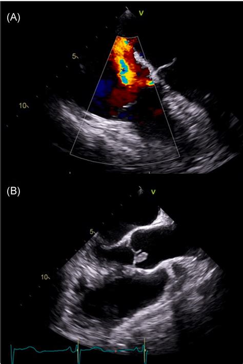 A Transesophageal Echocardiogram Demonstrating A Newly Found Native Download Scientific