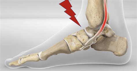Front Of Ankle Pain Anterior Ankle Impingement Dr Justin Dean