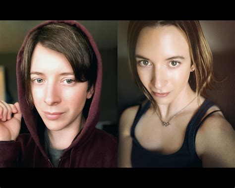 One Year Can Make A Huge Difference Left 36 Right 37 16 Months Hrt