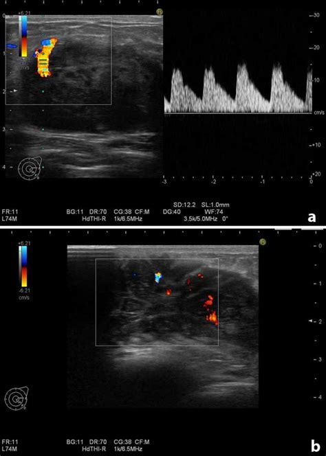 Ultrasound Findings In A Case Of Myeloid Sarcoma Of The Breast