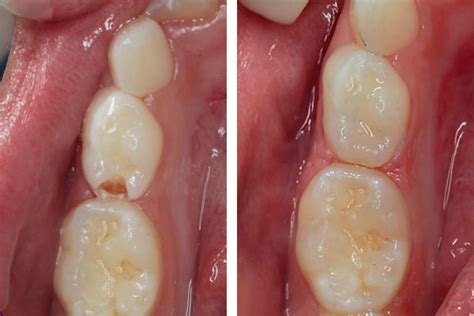 Restauração em Dentes de Leite Dra Cintia Figueiredo