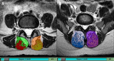 Multifidus Muscle Mri