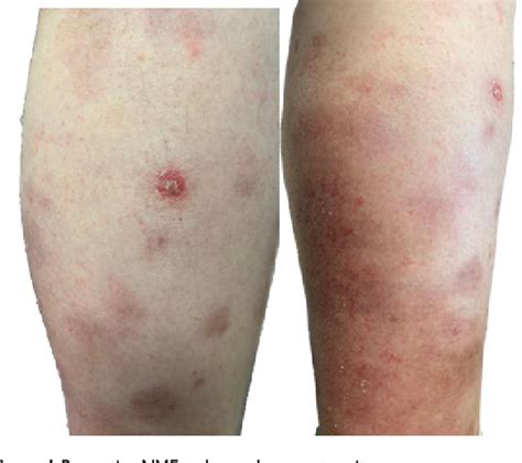 Figure 1 From Identifying Necrolytic Migratory Erythema In Glucagonoma Syndrome Semantic Scholar