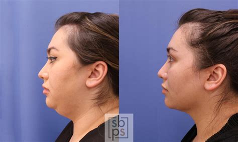 Chin Liposuction Before And After Pictures Case 472 Los Angeles