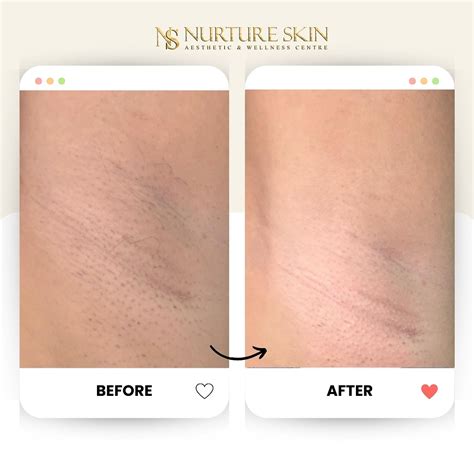 NS | Nurture Skin Aesthetic & Wellness Centre (@nurtureskinaesthetics ...