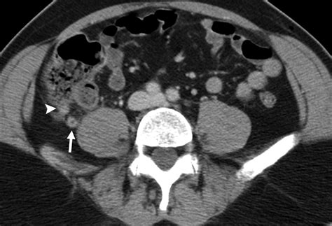 Pylephlebitis