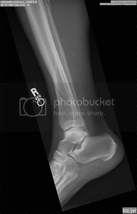 Need Dr's opinion on a tib fib fracture - Health & Fitness - ThumperTalk