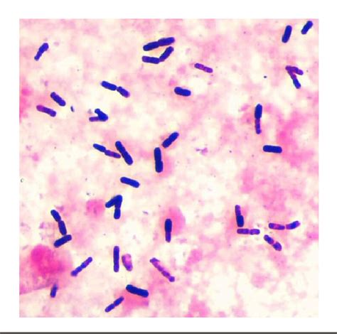 Figure 2 from Bacillus pumilus cellulitis with bacteremia in a person ...