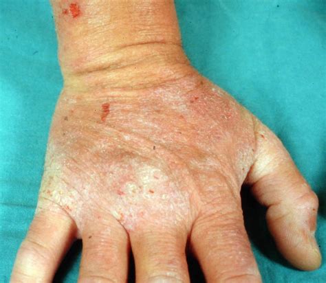 Dermatitis Herpetiformis Gluten Rash Everything To Know