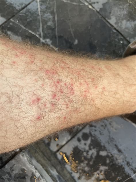 What are these bumps on my legs? Traveling in Vietnam : r/Dermatology