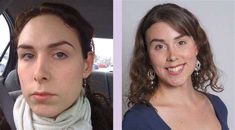 Dr Chettawut Sex Reassignment And Facial Feminization Surgery Center Facial Feminization