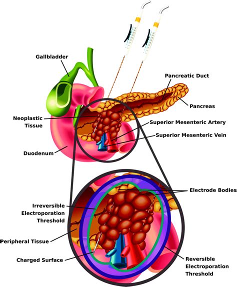 Irreversible Electroporation Background Theory And Review Of Recent