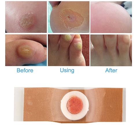 Aomeily Medicated Corn Removal Pads, 12 Pcs Set, Salicylic Acid