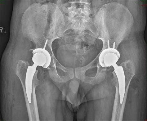 Hip and Groin Surgery (Hip Replacement and More) | Trambellir