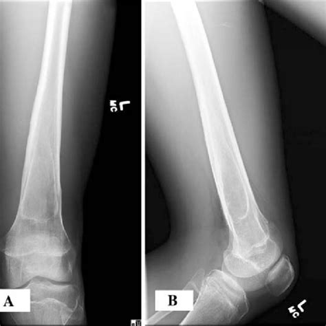 AB At The 20 Month Followup A AP And B Lateral Radiographs Of The