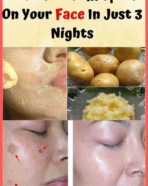 It Removes All Spots On Your Face In Just Nights Face Dark Spot