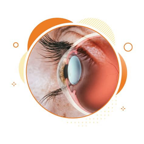 Insurance Cover In Cataract Surgery Best Eye Hospital In Thane Eye