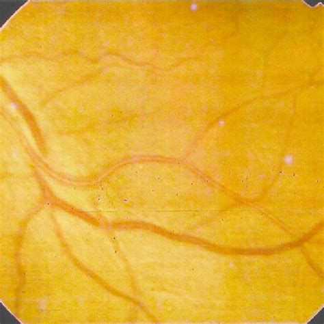 grade ii hypertensive retinopathy  scientific diagram