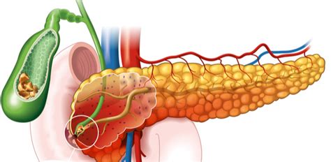 Quando A Pedra Da Vesícula Desce Para O Pâncreas Sintomas - Pedra na Vesícula: 11 fatores de risco para desenvolver a doença - DR ...