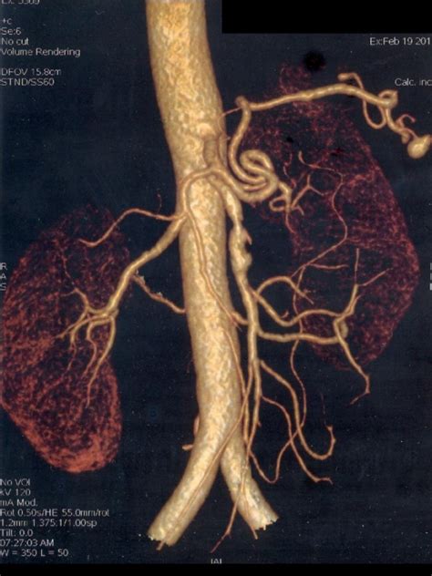 Superior Mesenteric Arterial Dissection Pacs