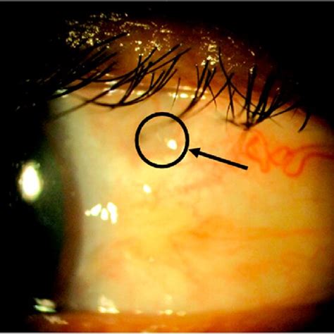 Nodular Scleral Mass In The Superior Temporal Quadrant Of The Left Eye