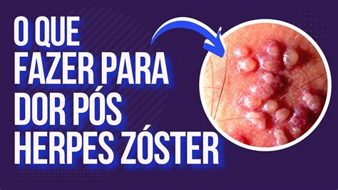 Remedio Para Aliviar A Dor Da Herpes Zoster