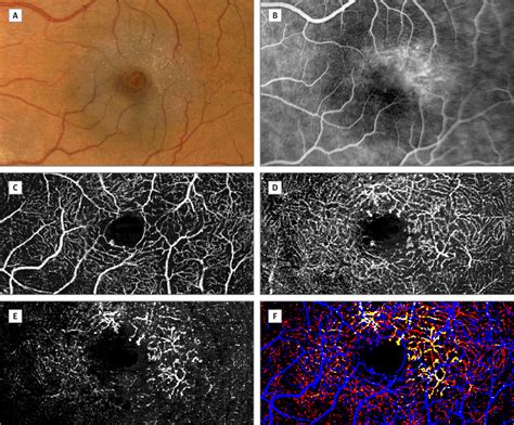 Retinal Vascular Layers In Macular Telangiectasia Type 2 Ophthalmic