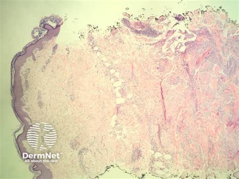 Churg Strauss Syndrome Pathology