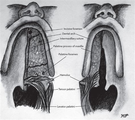 12 Cleft Palate Repair The Furlow Double Opposing Z Plasty The Von