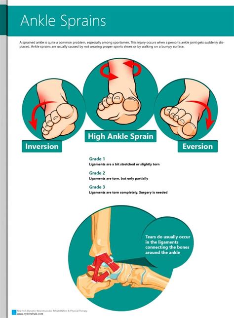 Ankle Sprains causes and symptoms. Ankle sprain grades
