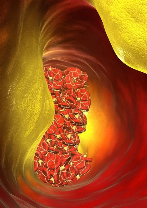 blocked artery computer artwork photograph  david mack fine art