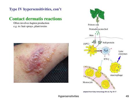 PPT - Hypersensitivity and Autoimmunity PowerPoint Presentation, free