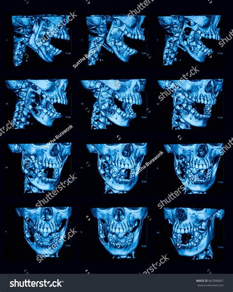 21 Tumors Jaws 3d Images Stock Photos Vectors Shutterstock