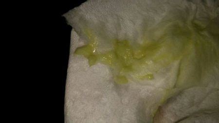 Corrimento Esverdeado Na Gravidez Prejudica O Bebê - Corrimento verde na gravidez é normal?