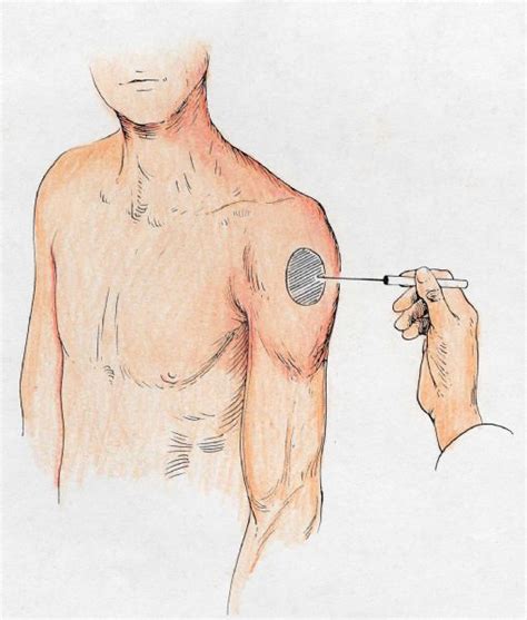 Axillary Nerve Dysfunction