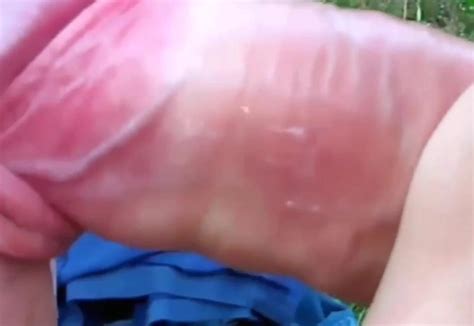 Lupus Porn Videos XHamster