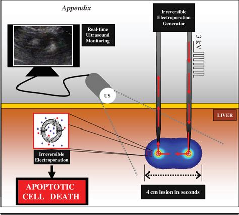 Imaging Guided Percutaneous Irreversible Electroporation Ultrasound