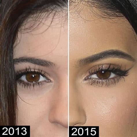 Kylie Jenner Before and After Plastic Surgery Photos Reveal Drastic