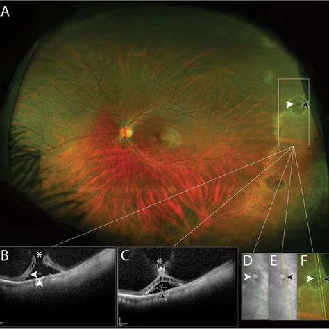 Typical Cystoid Degeneration Tcd A Uwf Color Image With Tcd Near Download Scientific