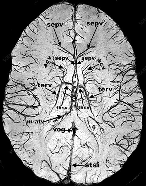 Swi Mri