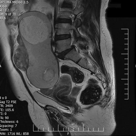 A Contrast Enhanced Computerized Tomography Scan Showing A Complex