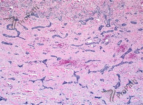 Morpheaform Basal Cell Carcinoma Histology